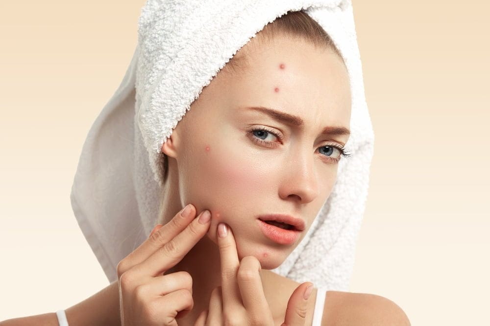 The Best Skin Care Products for Acne A Comprehensive Guide