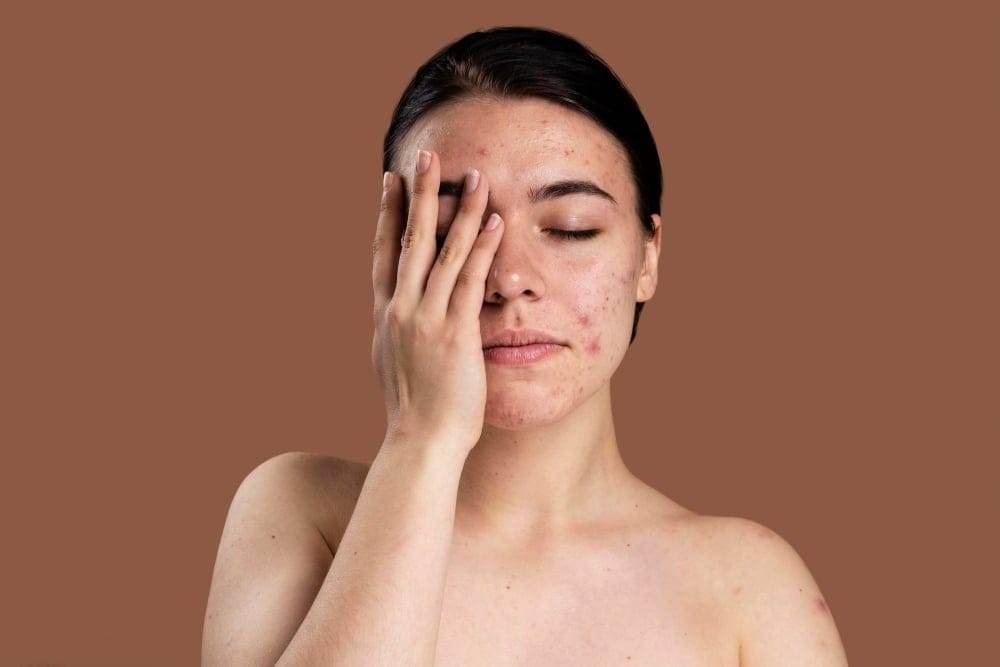 The Best Skin Care Products for Acne: A Comprehensive Guide