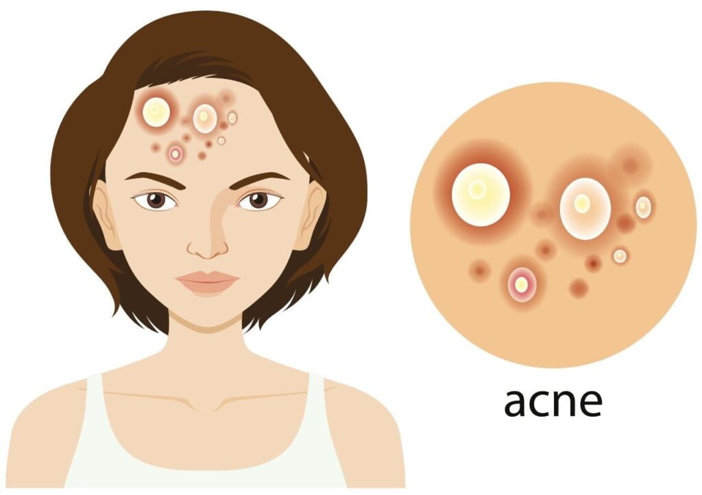 The Best Skin Care Products for Acne: A Comprehensive Guide